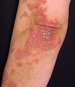 Pikkelysömör (psoriasis) tünetei, kezelése