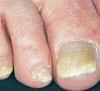 kezelés fungi nail art népi gyógyászat küzdelem gomba körmök lábak