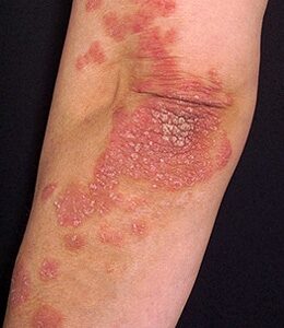 pikkelysömör kezelése kiemelkedő vörös foltok jelennek meg a lábujjakon és viszketnek