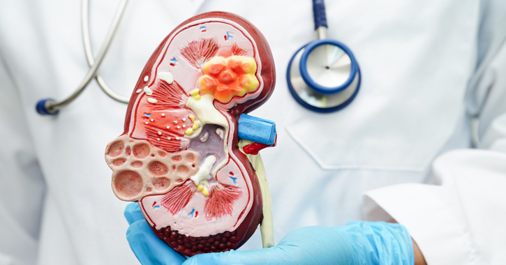 A Wilms tumor, vagyis a vesedaganat