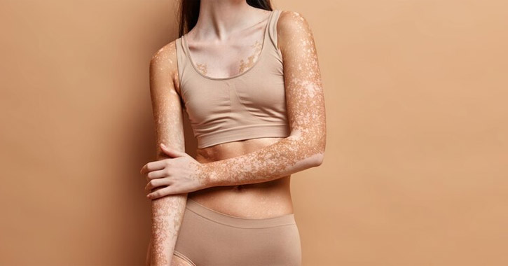 Vitiligo: fehér foltok a bőrön
