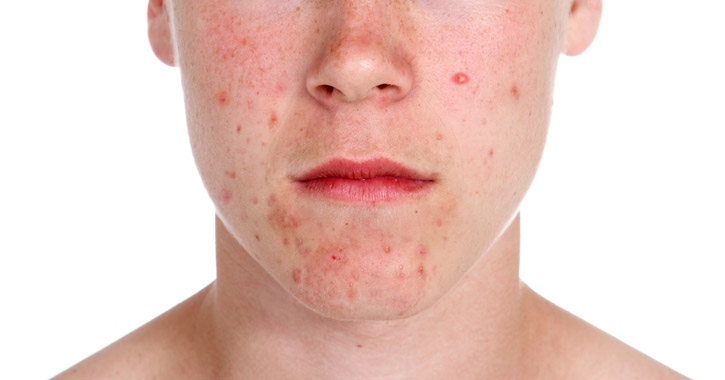 Pattanások - mikor érdemes bőrgyógyászt felkeresni?