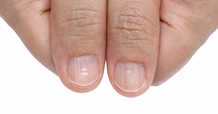 Mitől töredezik a körmöd? Tényleg a kalciumhiány az oka?