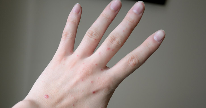 Kéz-láb-száj betegség – Mi is ez?