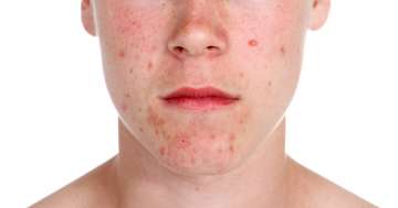 Pattanások - mikor érdemes bőrgyógyászt felkeresni?