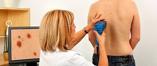 A férfiakra veszélyesebb a melanoma