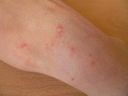 a papilloma rák kezelése