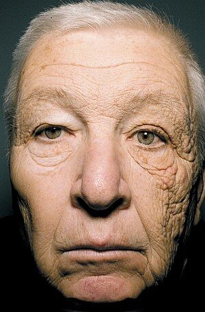 http://www.livescience.com/20743-photo-sun-damage-skin-cancer.html