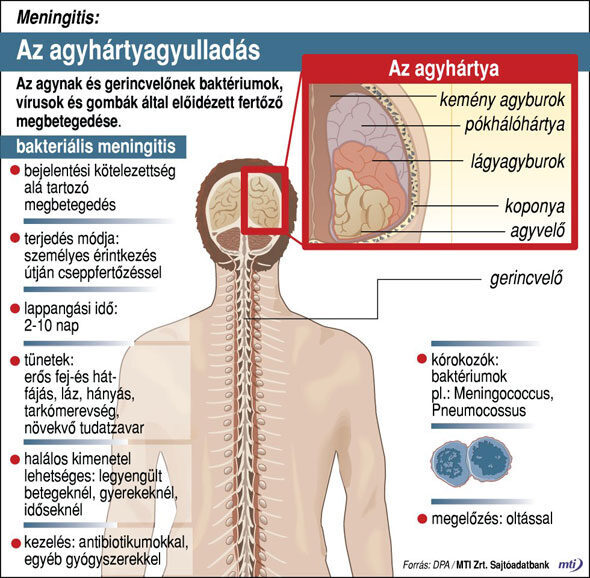 Agyhártyagyulladás MTI infografika