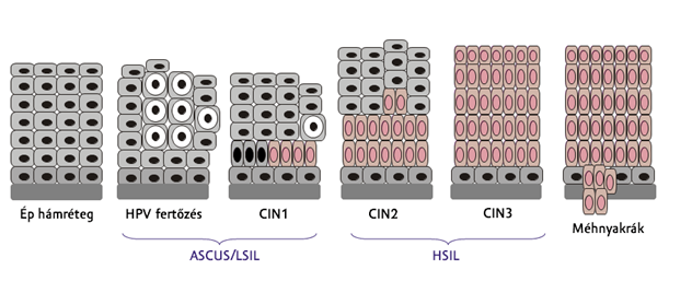 Méhnyakrák citológiai lelet, CIN skála